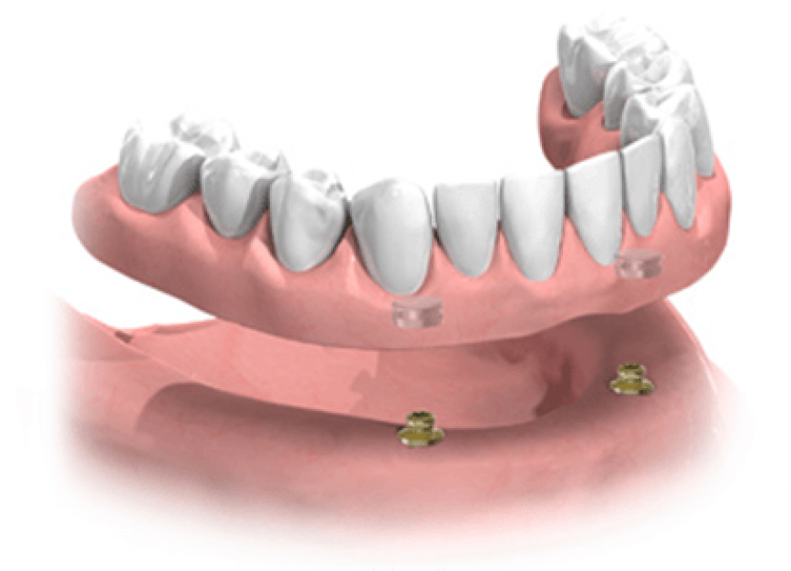 Equator Denture