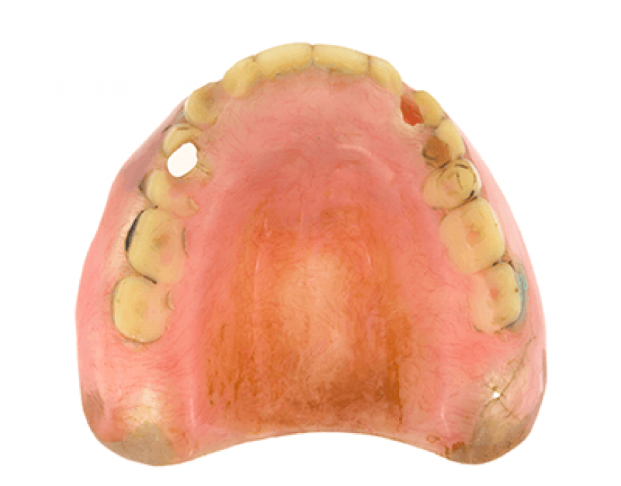 denture-replacement
